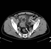 A Case-Report on Diverticulitis Misdiagnosed As Tubo-Ovarian Abscess